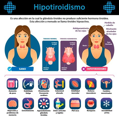 HIPOTIROIDISMO .